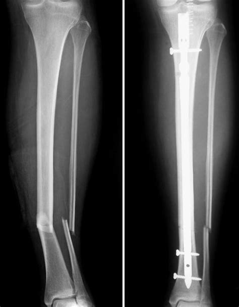 Define compound fracture - seryjam