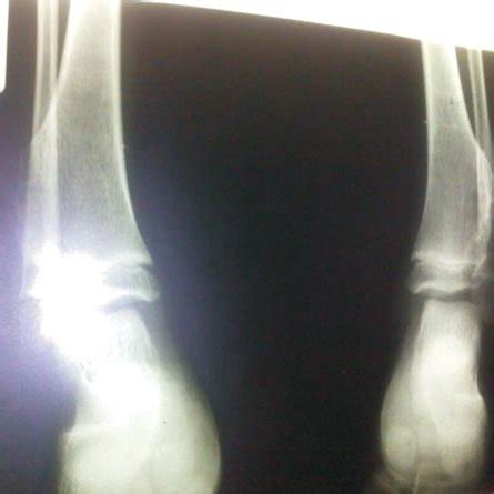 (PDF) Hereditary Multiple Exostoses: A Case Report