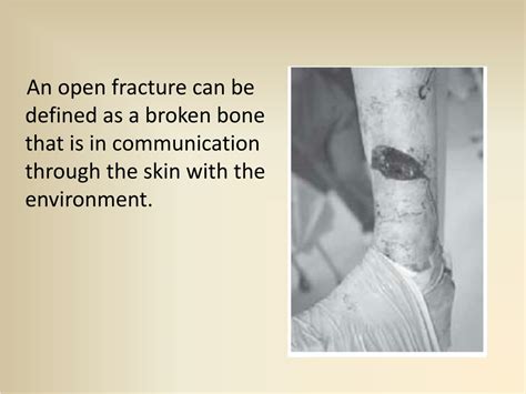 PPT - OPEN (COMPOUND) FRACTURES PowerPoint Presentation, free download ...