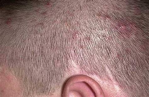 10 Home Remedies for Scalp Folliculitis - Home Remedies