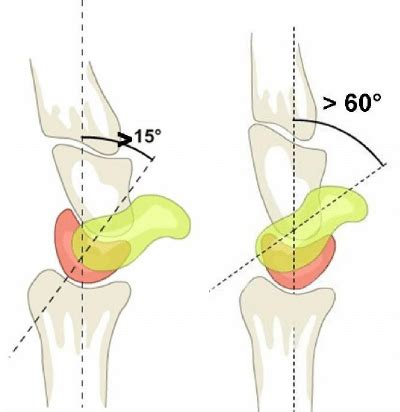 In case of rotary subluxation of the scaphoid (scapholunate angle ...