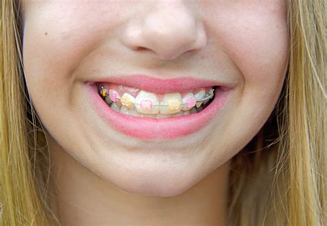 clear_braces_color_bands - Hardy Pediatric Dentistry & Orthodontics