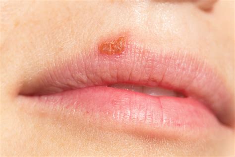 Pictures of Shingles Rash (part 2) | Shingles Expert