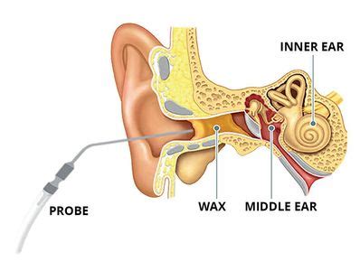 The Hearing Specialist - Ear Wax Removal - Mount Eliza, Victoria