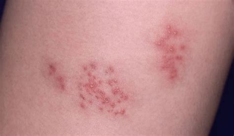 Heat Rash versus Shingles- Know the difference!