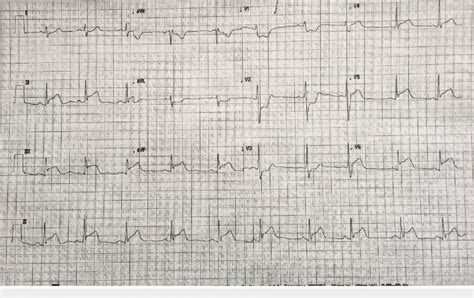 Posterior Wall Mi 12 Lead Ecg