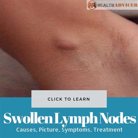 Swollen Lymph Nodes Under The Arm : Causes, Symptoms, Treatment