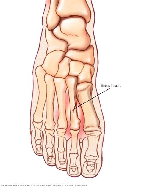 Do You Know About Stress Fracture, A Very Common Sports Injury | Playo