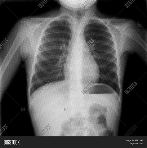 Plain Chest X-Ray Image & Photo (Free Trial) | Bigstock