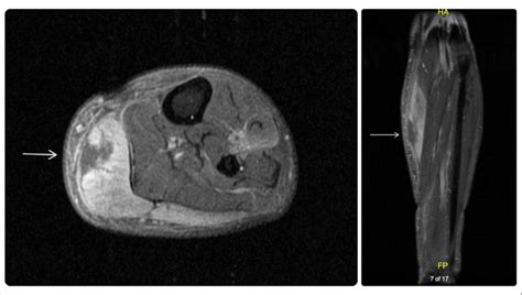 Left calf MRI axial and coronal FSE T1 with contrast. MRI shows a ...