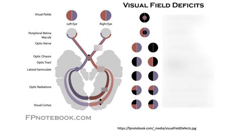 Cranial Nerve Lesions Diagram | Quizlet