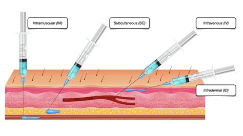 Intravenous Injection Sites