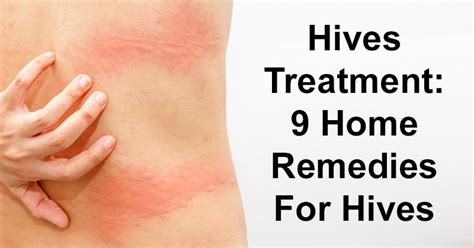 Hives Treatment - fasrsp