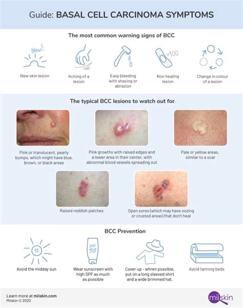 Basal Cell Carcinoma - Symptoms, Types and Pictures