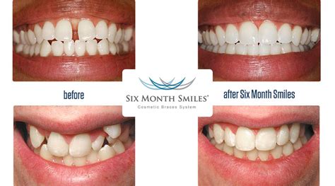 Buckhead GA Six Month Smiles Dentist | Adult Clear Braces, Invisible