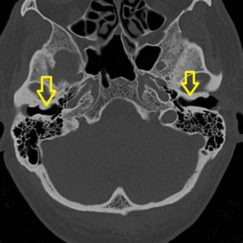 Exostosis of the external auditory canal (also known as surfer's ear ...