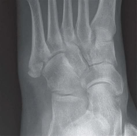 Base of Fifth Metatarsal Fracture | Radiology Key