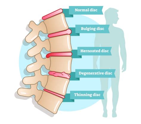 Disc Bulge Treatment: Disc Bulge Therapy, Symptoms & Causes | QI Spine