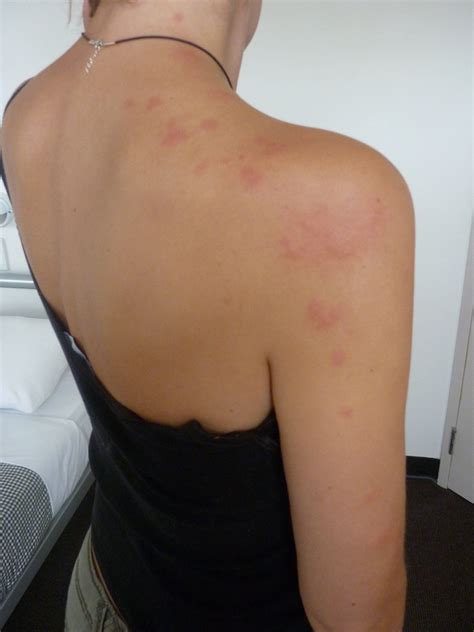 Bed Bug Bites | Bed bug bites, Signs of bed bugs, Bed bugs