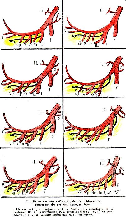 Image of variations in origin of the obturator artery arising from the ...