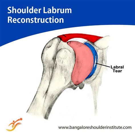 Shoulder Reconstruction surgery involves repair of the injured or ...