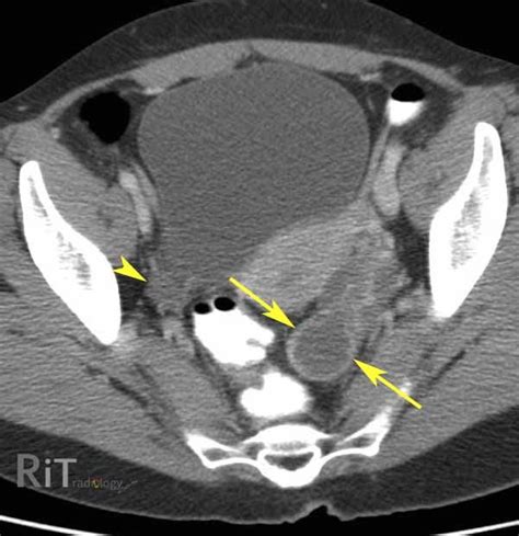 RiT radiology: Tubo-ovarian Abscess