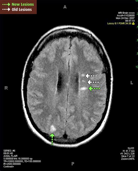 Understanding Your MRI | MS Living Well