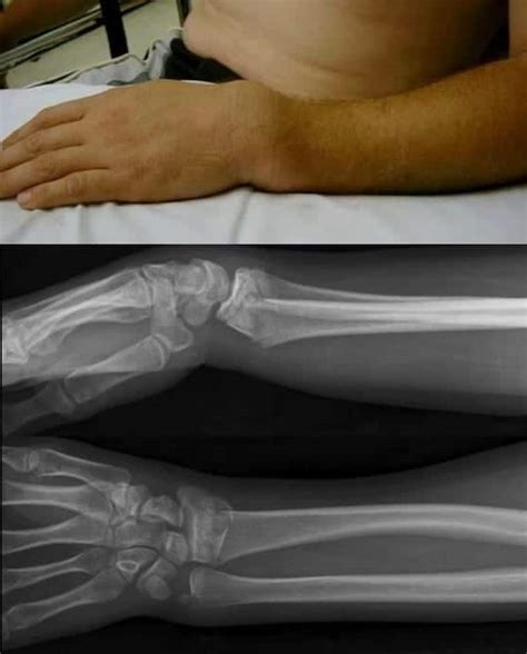 Colles fracture • LITFL • Medical Eponym Library