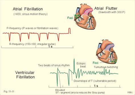 Ventricular Fibrillation, Clinical Manifestation, Diagnosis, And ...