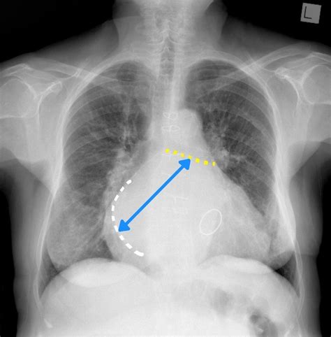 Left atrial enlargement | Radiology Case | Radiopaedia.org Size of the ...