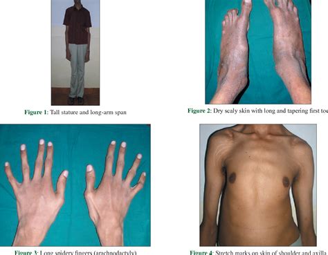 Figure 3 from Marfan syndrome: report of two cases with review of ...