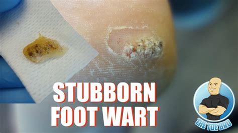 Plantar Wart Root Removal Surgery | Bruin Blog