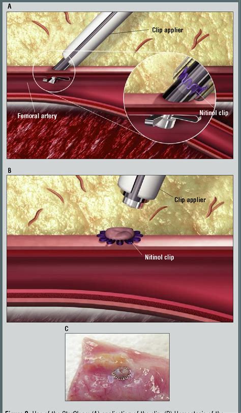 Figure 2 from Complications of femoral artery access during cardiac ...