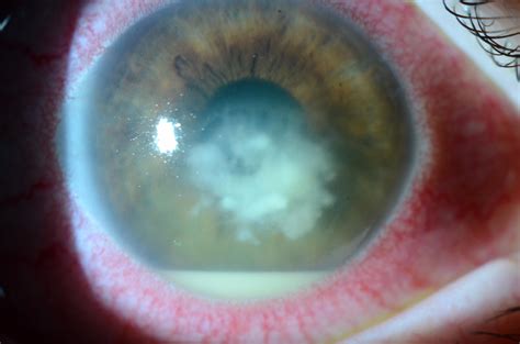 Taking a closer look at fungal keratitis - EyeWorld