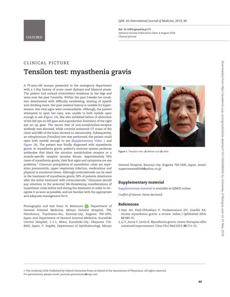 (PDF) Tensilon Test: Myasthenia Gravis