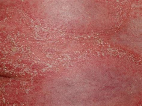 Generalised pustular psoriasis