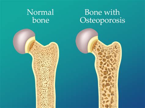 How to Prevent Osteoporosis | 6 Ways to Avoid it | Orthopedic Institute ...