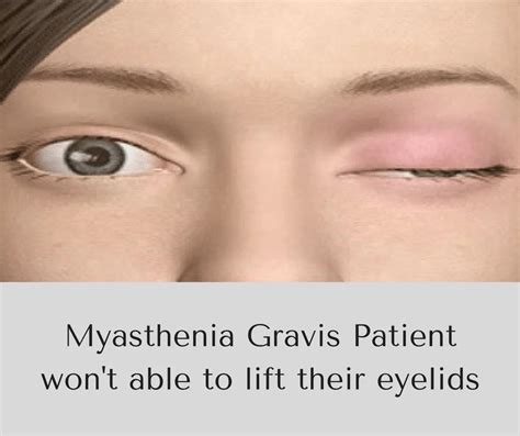 myasthenia-gravis-causes-symptoms-and-treatment-min