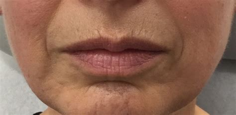 Dermal Fillers Lips Before And After | Lipstutorial.org