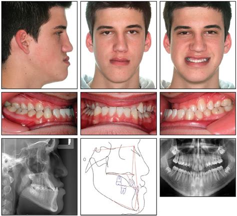 Nonsurgical Correction of Severe Skeletal Class III Malocclusion - JCO ...