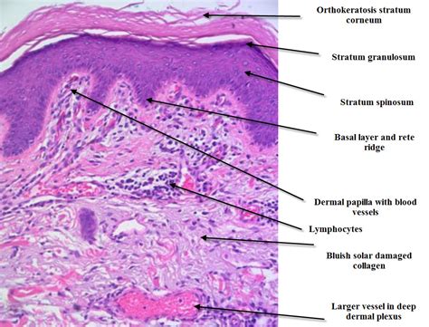 Dermatopathology Made Simple - Inflammatory: Introduction to skin ...