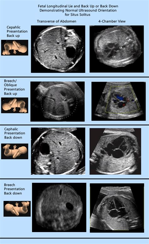 types of fetal presentation ultrasound