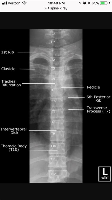 AP Thoracic Spine xray | Radiology student, Medical anatomy, Radiology ...