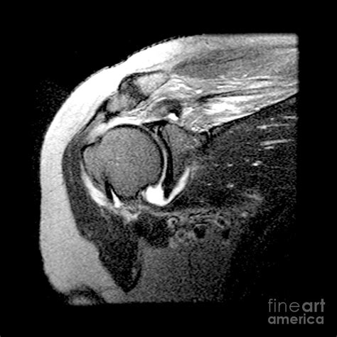 Rotator Cuff Tear Photograph by Medical Body Scans - Pixels