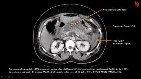 Ultimate Radiology : Acute Necrotizing Pancreatitis