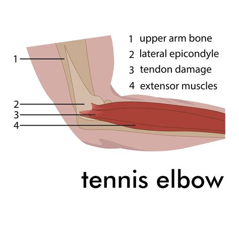 Tennis elbow treatment, What is it & how to cure it - Newcastle ...