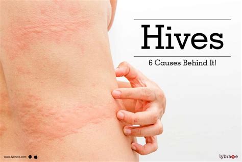 Hives Rash or Urticuria - 6 Cause Behind Skin Disorder - By Kaya Skin ...