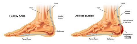 Achilles Bursitis: Symptoms, Causes, Treatment By Ankle Braces