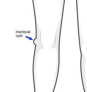 Meniscal cyst | KNEEguru