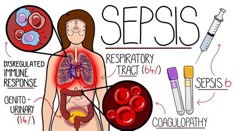 Understanding Sepsis (Sepsis Explained Clearly) - YouTube Music